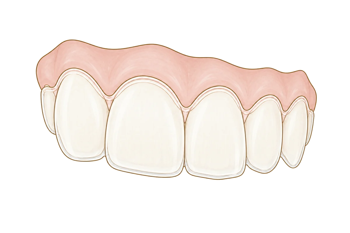 Illustration of a clear aligner tray fitted over a row of upper front teeth