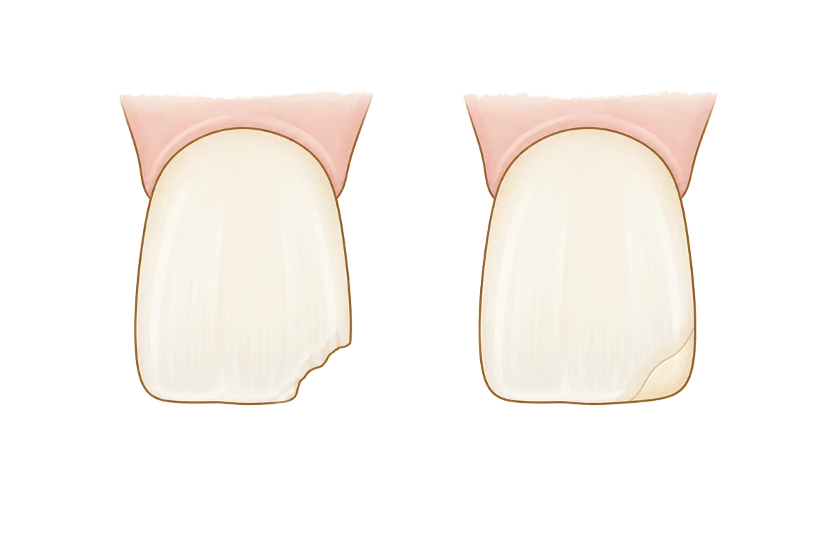 Illustration of a front tooth with a chipped corner, and the same tooth with the corner rebuilt in tooth-coloured composite