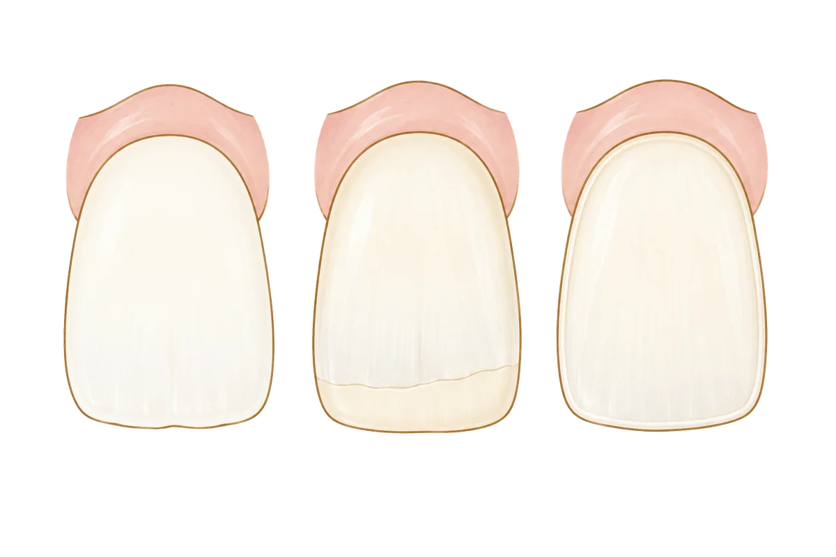 Illustration of three front teeth: one whitened, lighter than the other two, one with its edge built up by bonding, and one covered by a thin veneer