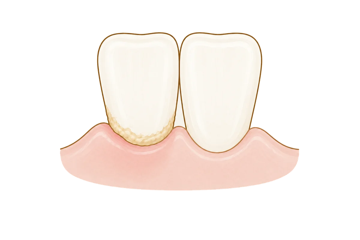 Illustration of two front teeth: one with hardened tartar along the gum line, the other clean with a healthy gum line