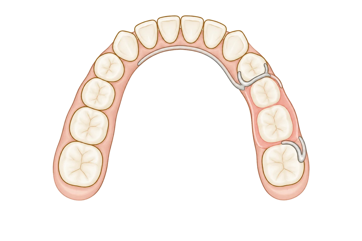 Illustration of a lower dental arch from above, with a partial denture replacing two missing teeth, held by clasps on the neighbouring teeth