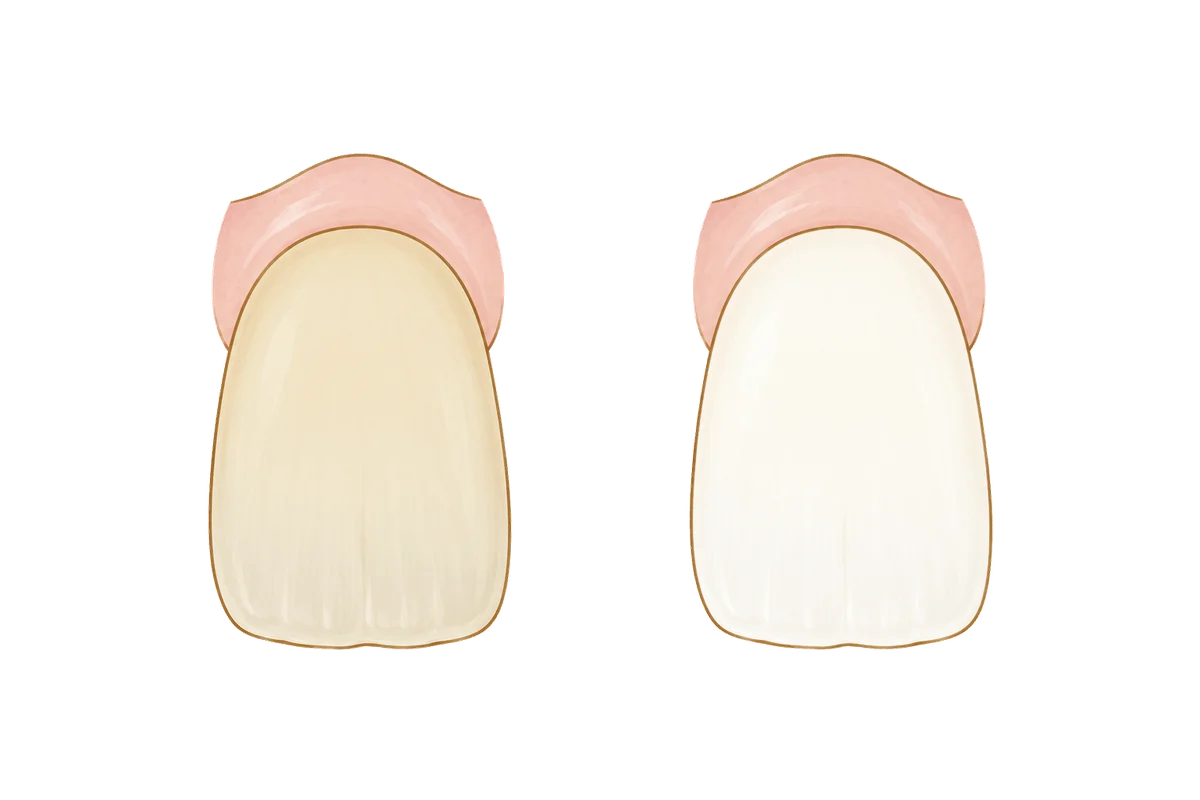 Illustration of the same front tooth twice: before whitening, a darker, warmer natural shade, and after whitening, lighter